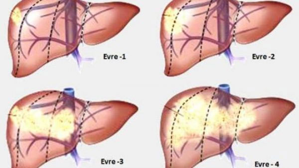 Tiến triển của bệnh xơ gan